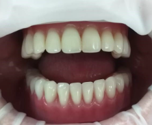 Имплантация зуба при помощи имплантата IMPLANTIUM 