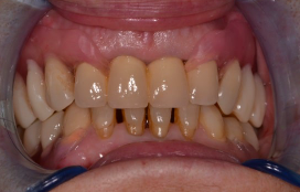 Комплексное протезирование зубов