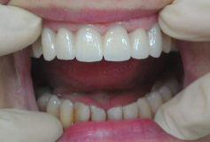 Функционально-эстетическое восстановление передней группы зубов Безметалловыми коронками