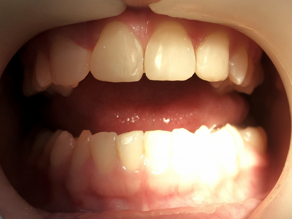 Реставрация центральных резцов. Уменьшение щели между передними зубами.