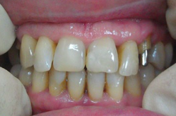 Функционально-эстетическое восстановление передней группы зубов Безметалловыми коронками