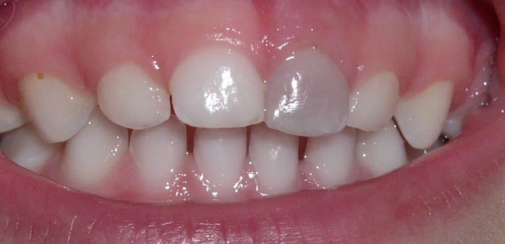 Почему чернеют зубы и как с этим бороться